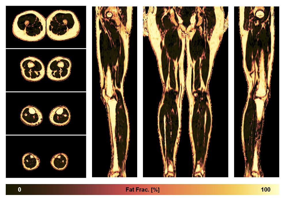 The fat fraction of the lower extremity obtained from the dixon reconstruction for muscle water fat quantification.